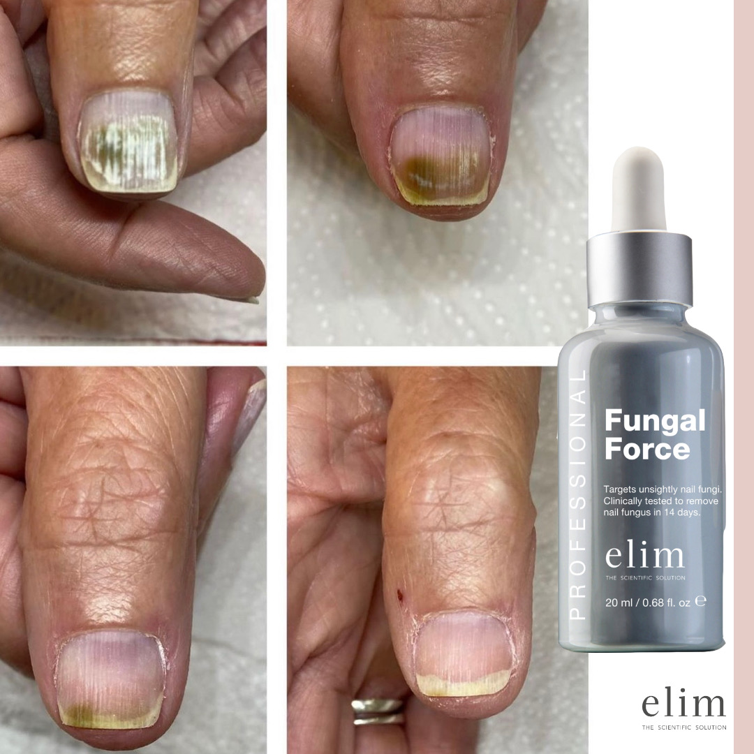 ELIM | Fungal Force 20 ml
